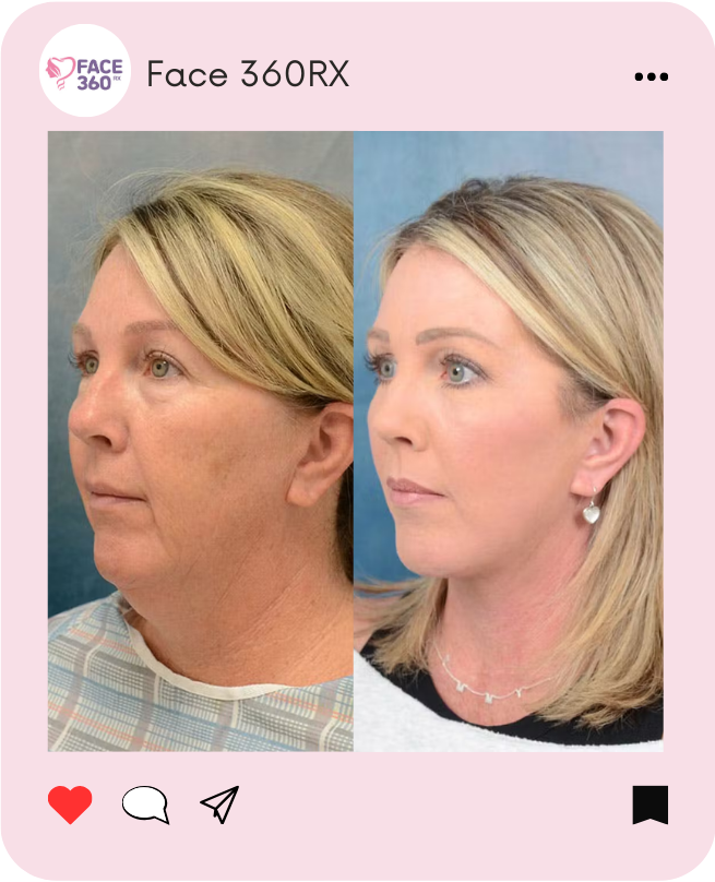 A before-and-after image of a woman's face, digitally altered to show the effects of facial contouring. The "before" image on the left shows a softer jawline and less defined cheekbones. The "after" image on the right shows a more sculpted and defined jawline and higher, more prominent cheekbones.