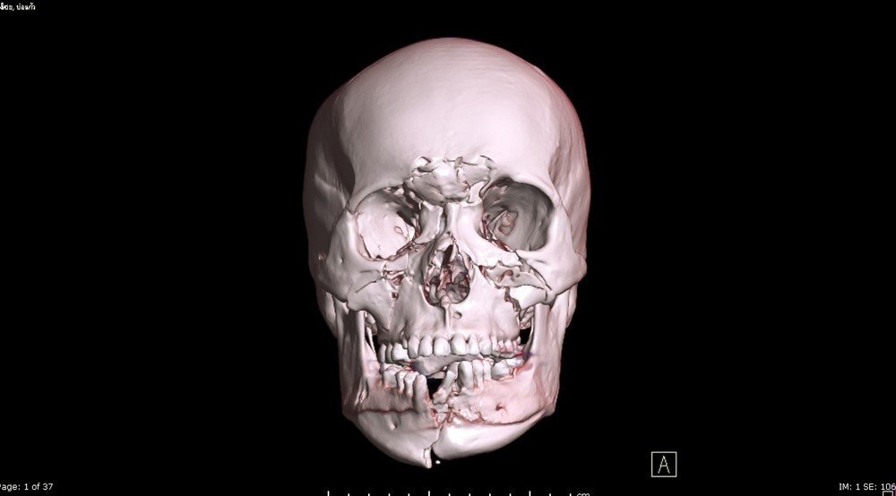 A 3D reconstructed CT scan of a human skull with visible fractures to the mandible (lower jaw).