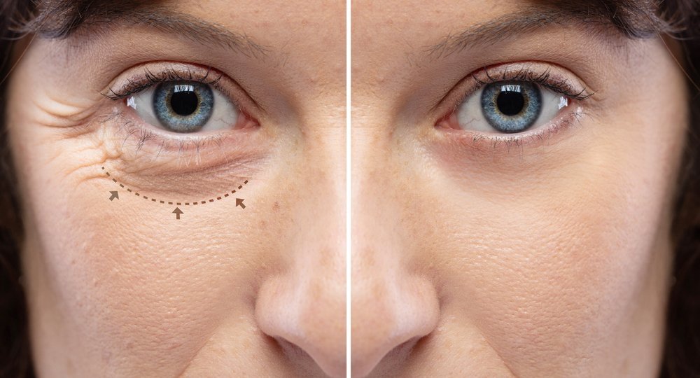 A split close-up photograph of a woman's left eye area: "Before" (left) shows visible crow's feet wrinkles with overlaid dotted lines and arrows, and "After" (right) shows significantly reduced wrinkles and smoother skin, illustrating the results of a cosmetic treatment.