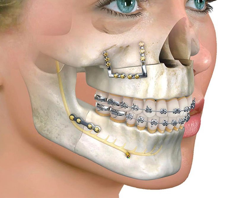 "Medical illustration of orthognathic (corrective jaw) surgery showing braces on upper and lower teeth, repositioned jawbones secured with metal plates and screws, and the highlighted inferior alveolar nerve."