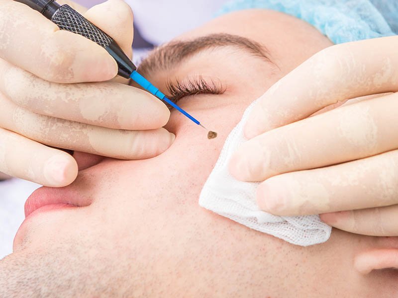Close-up of a person's face undergoing mole removal with a specialized tool and gloved hands.