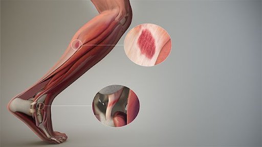 Medical illustration showing the muscles of the lower leg and foot, with inset circles highlighting a muscle tear in the calf and a ruptured Achilles tendon near the heel.